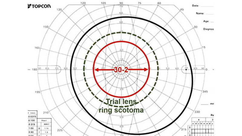 Topcon visual field test chart with labeled zones, grid markings, and patient info fields.